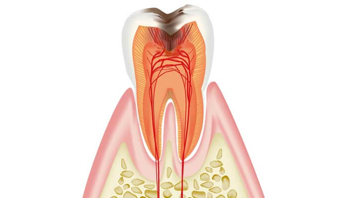 歯髄(神経)に達した虫歯