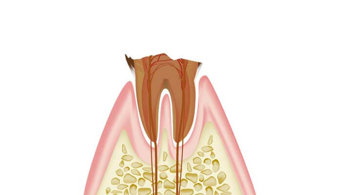 歯質が失われた虫歯