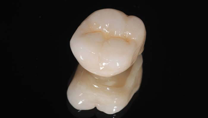 オールセラミック