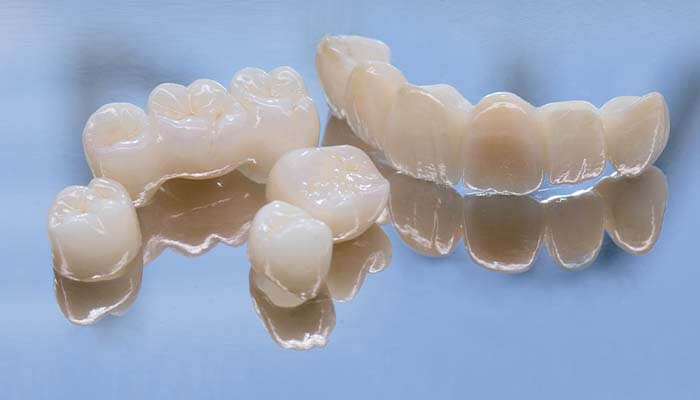 オールセラミック